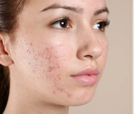 acne scars treatment