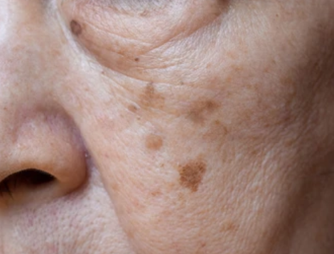 age spots treatment