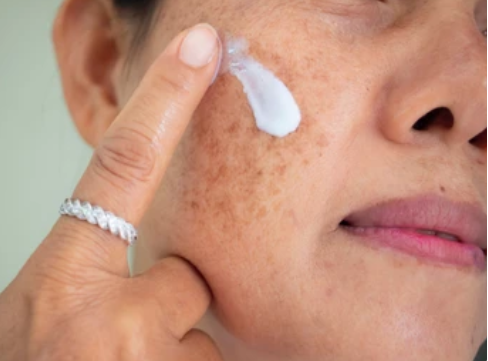 age spots treatment 2