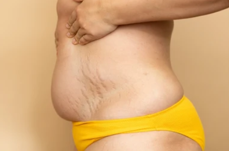 stretchmarks treatment online 2