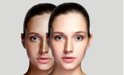 pigmentation treatment online2